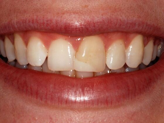 Before Cosmetic Dental Treatment